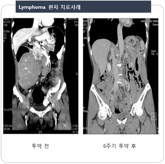 림프종 환자 투약 전과 6주기 투약 후 CT 영상 비교